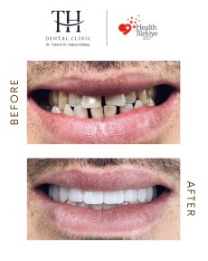Efekt przed i po implantach All-on-4 w TH Dental Clinic – odbudowa uśmiechu