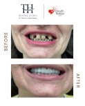 Efekt przed i po implantach All-on-4 w TH Dental Clinic – odbudowa uśmiechu