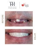 Efekt przed i po implantach All-on-4 w TH Dental Clinic – pełna odbudowa uśmiechu