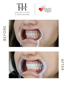 Efekty licówek przed i po w TH Dental Clinic – metamorfoza uśmiechu i bielsze zęby