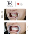 Efekty licówek przed i po w TH Dental Clinic – metamorfoza uśmiechu i bielsze zęby