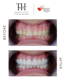 Efekty przed i po licówkach w TH Dental Clinic – bielszy, równy uśmiech