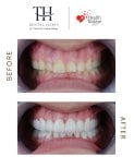 Efekty przed i po licówkach w TH Dental Clinic – bielszy, równy uśmiech