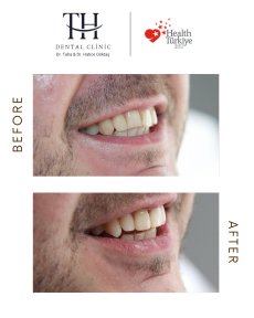 Efekt przed i po licówkach w TH Dental Clinic – poprawiona estetyka uśmiechu