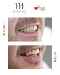 Efekt przed i po licówkach w TH Dental Clinic – poprawiona estetyka uśmiechu