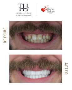 Efekty przed i po licówkach w TH Dental Clinic – bielszy, równy uśmiech