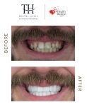 Efekty przed i po licówkach w TH Dental Clinic – bielszy, równy uśmiech