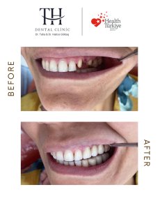 Efekty przed i po licówkach w TH Dental Clinic – naturalna metamorfoza uśmiechu