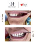 Efekty przed i po licówkach w TH Dental Clinic – naturalna metamorfoza uśmiechu
