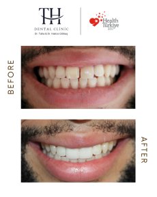 Efekt przed i po licówkach w TH Dental Clinic – bielszy, odmieniony uśmiech