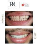 Efekt przed i po licówkach w TH Dental Clinic – bielszy, odmieniony uśmiech