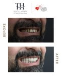 Efekt przed i po licówkach w TH Dental Clinic – poprawa estetyki uśmiechu mężczyzny