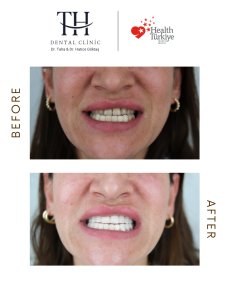 Before and after veneers at TH Dental Clinic – smile makeover with whiter, even teeth result