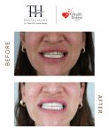 Before and after veneers at TH Dental Clinic – smile makeover with whiter, even teeth result