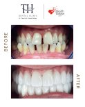 Before and after dental veneers at TH Dental Clinic – smile makeover and whiter teeth result
