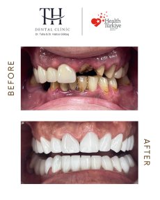 Before and after veneers at TH Dental Clinic – smile makeover with natural-looking results