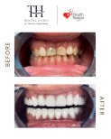 Before and after veneers at TH Dental Clinic – smile transformation and whiter teeth result