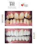 Before and after dental veneers at TH Dental Clinic – smile transformation result
