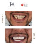 Before and after veneers at TH Dental Clinic – smile makeover and whiter, aligned teeth result
