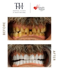 Before and after veneers at TH Dental Clinic – smile transformation and whiter teeth result