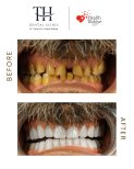 Before and after veneers at TH Dental Clinic – smile transformation and whiter teeth result