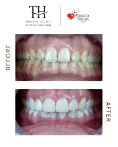 Before and after veneers at TH Dental Clinic – smile transformation and whiter teeth result
