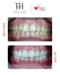 Before and after veneers at TH Dental Clinic – smile transformation and whiter teeth result