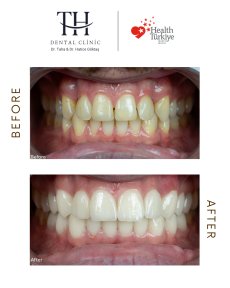 Before and after dental veneers at TH Dental Clinic – smile transformation results