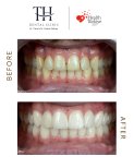 Before and after dental veneers at TH Dental Clinic – smile transformation results