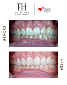 Before and after dental veneers at TH Dental Clinic – smile makeover with natural results