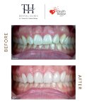 Before and after dental veneers at TH Dental Clinic – smile makeover with natural results