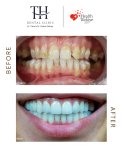 Before and after veneers result at TH Dental Clinic – smile makeover with whiter teeth