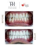 Before and after veneers result at TH Dental Clinic – smile transformation with whiter teeth