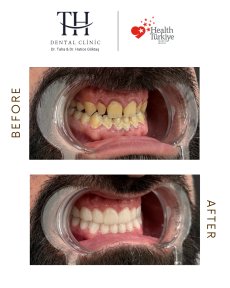 Before and after veneers at TH Dental Clinic – smile transformation and whiter teeth result