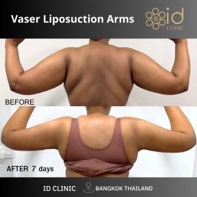 before-after photo 360-liposuction