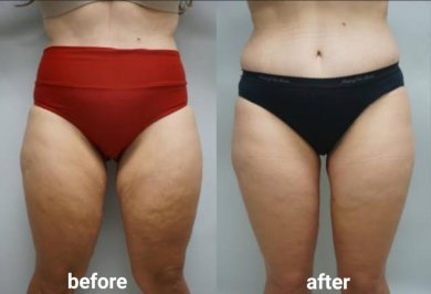 before-after photo vaser-liposuction
