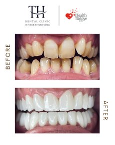 Before and after All-on-6 dental implants result at TH Dental Clinic – restored white smile