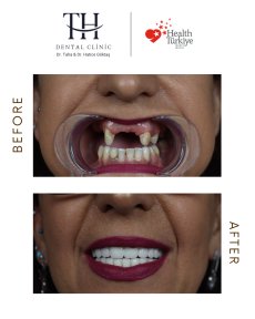 All-on-6 dental implants before and after result at TH Dental Clinic – full smile restoration