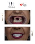 All-on-6 dental implants before and after result at TH Dental Clinic – full smile restoration