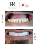Before and after All-on-6 dental implants result at TH Dental Clinic – smile transformation