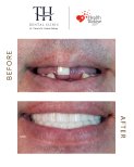 Before and after All-on-6 dental implants result at TH Dental Clinic – full smile restoration