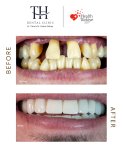 Before and after All-on-6 dental implants result at TH Dental Clinic, smile restoration
