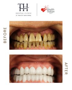 Before and after All-on-4 dental implants result at TH Dental Clinic – smile restoration