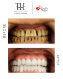 Before and after All-on-4 dental implants result at TH Dental Clinic – smile restoration