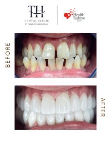 Before and after All-on-4 dental implants result at TH Dental Clinic – smile restoration