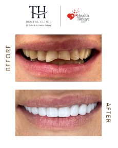 Before and after All-on-4 dental implants result at TH Dental Clinic – smile transformation
