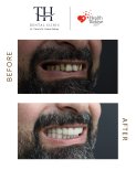 Before and after All-on-4 dental implants result at TH Dental Clinic – smile restoration