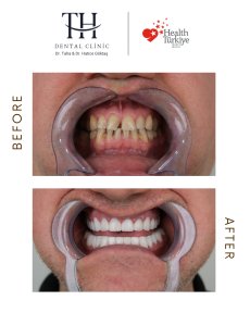 Before and after All-on-4 dental implants result at TH Dental Clinic – full smile restoration