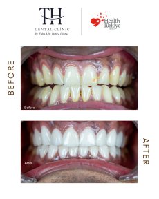 Before and after All-on-4 dental implants result at TH Dental Clinic – smile restoration