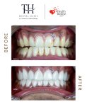 Before and after All-on-4 dental implants result at TH Dental Clinic – smile restoration
